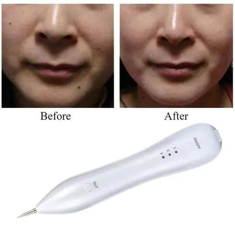 Mole Removal Pen, Beauty Needle, Beauty Device
